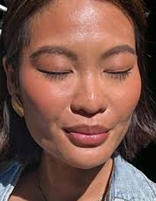 Platelet-Rich Plasma (PRP)