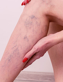Spider Vein Treatment
